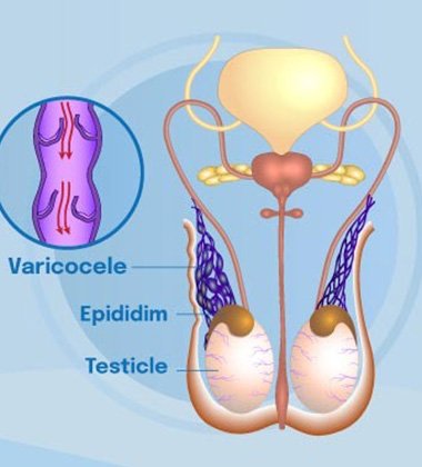 Microsurgical Varicocelectomy